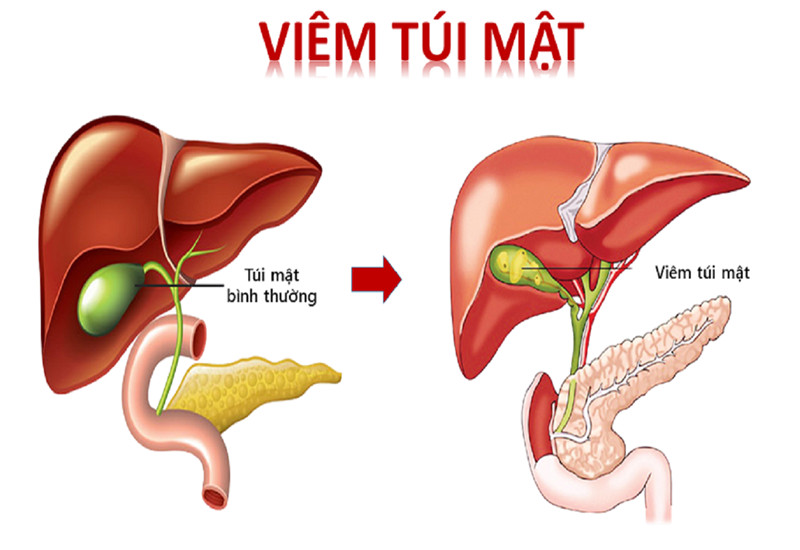 Tình trạng viêm túi mật là một trong những nguyên nhân gây nôn ra dịch mật