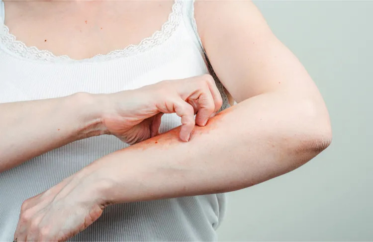 Vết bọ chét cắn trên da người gây ngứa và khó chịu