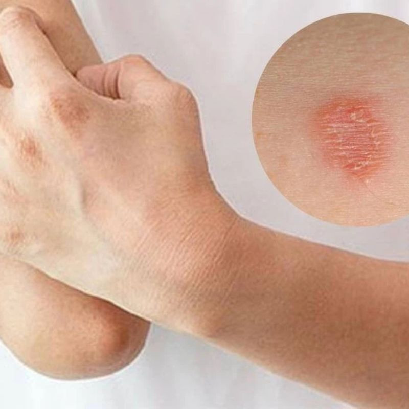 Vùng da bị nấm mèo ở người với các vết đỏ, ngứa và có vảy khô rõ rệt.