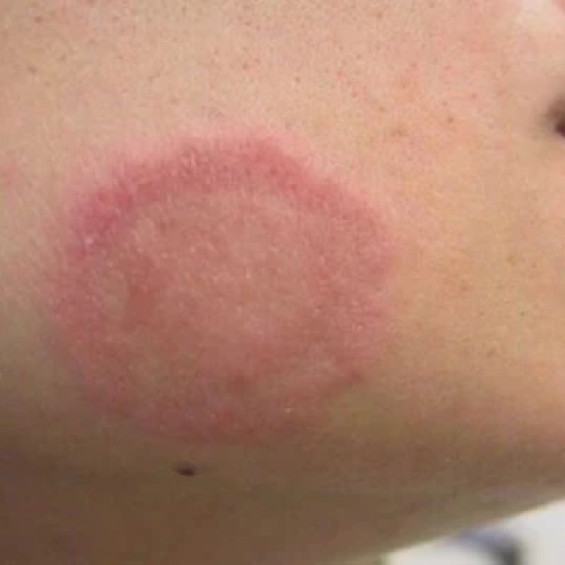 Bác sĩ da liễu đang khám và xem xét kỹ lưỡng vùng da bị ảnh hưởng của bệnh nhân để chẩn đoán nấm mèo.