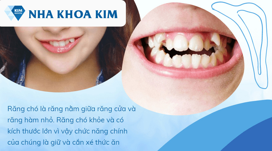 Hình ảnh cận cảnh một hàm răng có răng chó (răng nanh) dài và nổi bật