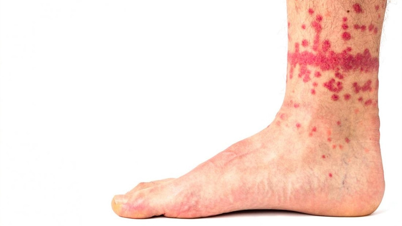 Vết cắn bọ chét trên da có thể gây nhiễm trùng nếu không được xử lý kịp thời và đúng cách