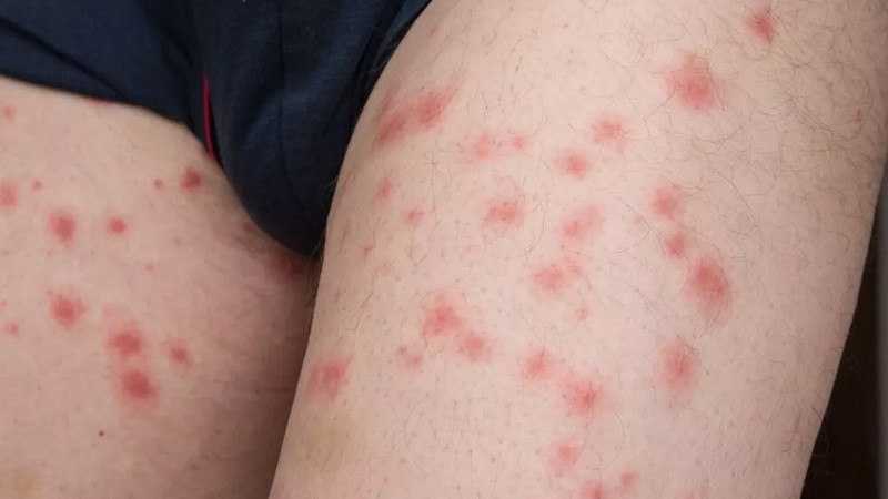 Vết cắn bọ chét rất nhỏ và có quầng đỏ bao xung quanh