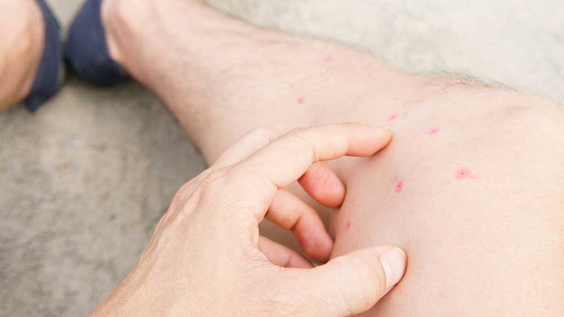 Vết cắn bọ chét có thể nguy hiểm cho da nếu bạn gãi quá mức