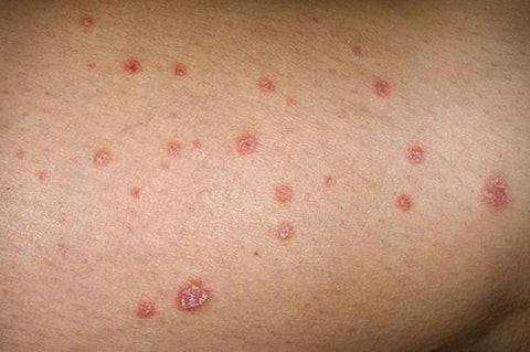 Các nốt ban đỏ hình tròn do nấm mèo gây ra trên da người