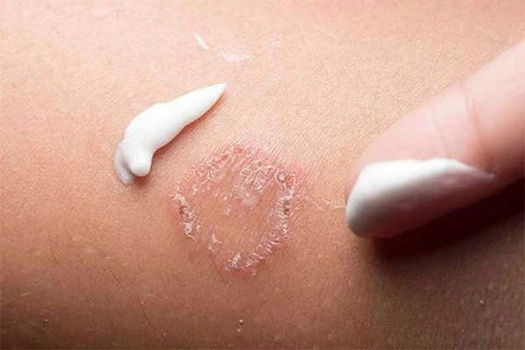 Thuốc bôi ngoài da giúp điều trị nấm mèo hiệu quả