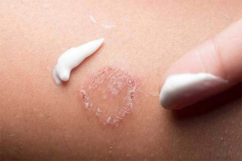 Thuốc bôi ngoài da Clotrimazole được dùng để điều trị nấm mèo ở người