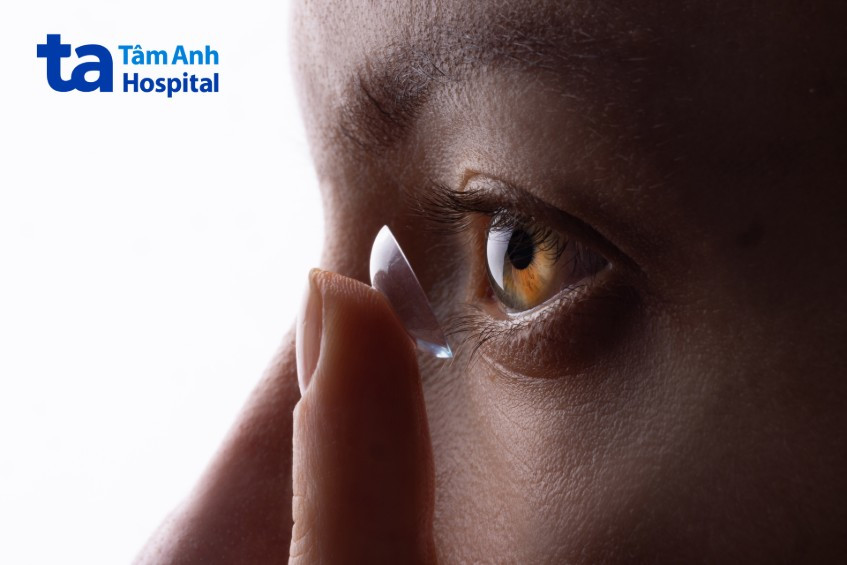 Đeo kính áp tròng đúng cách giúp hạn chế mắt đổ ghèn