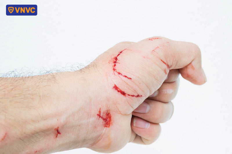 Vết cắn sâu và nhiều vết cắn có thể làm tăng lượng virus xâm nhập và rút ngắn thời gian ủ bệnh