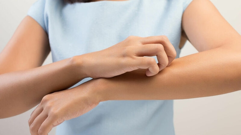 Mẩn ngứa da là một trong những dấu hiệu sán mèo phổ biến